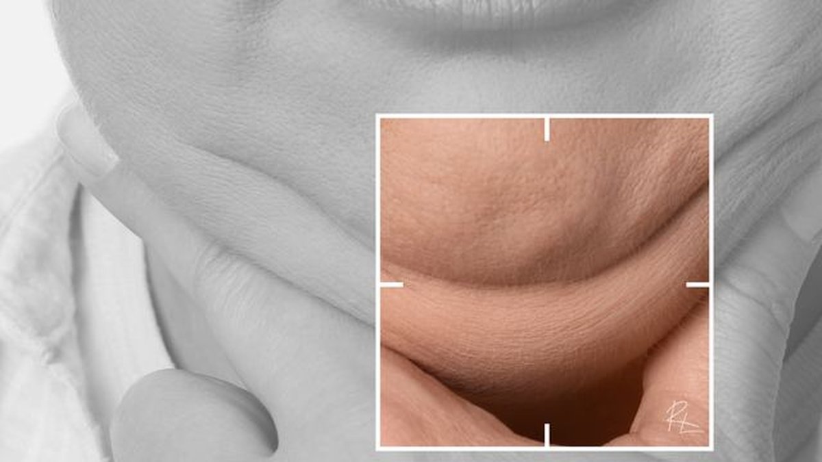 What is Exilis Ultra 360? RF and ultrasound at once — RL Beauty Lounge