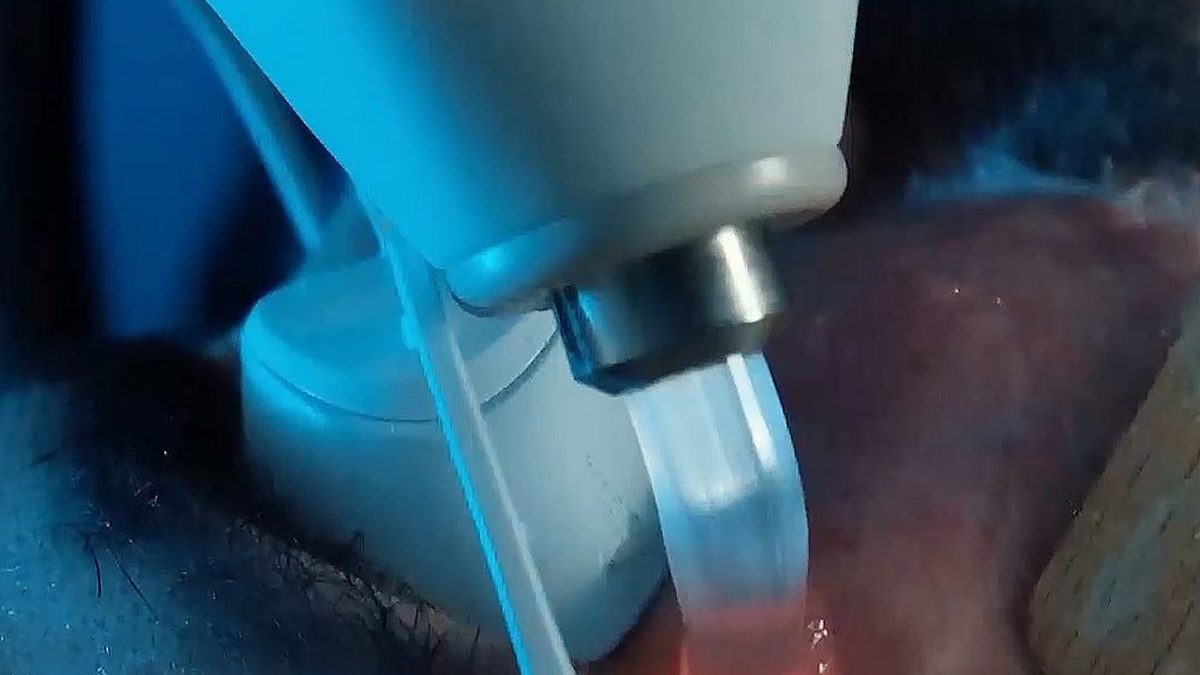 What determines laser hair removal prices? — RL Beauty Lounge