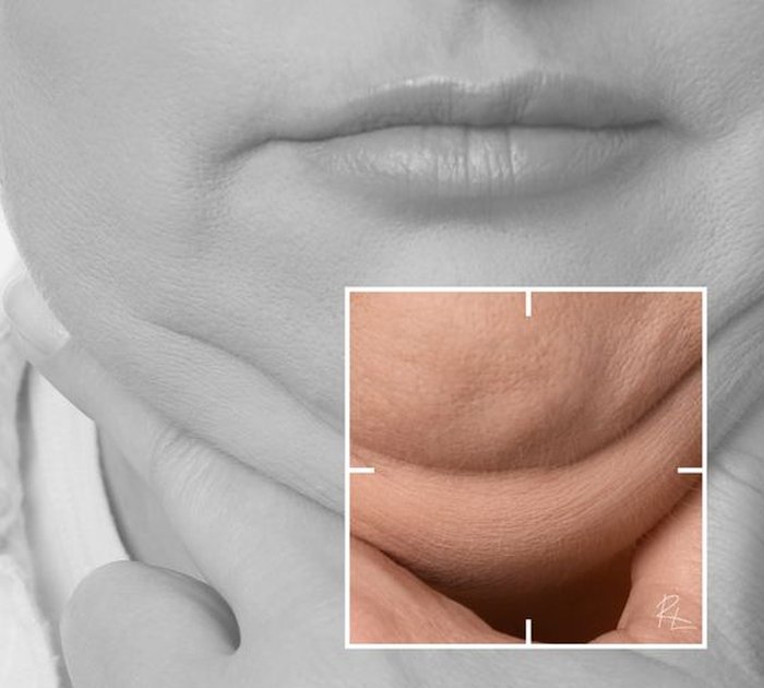 Exilis Ultra 360: Non-Surgical Face and Body Tightening — RL Beauty Lounge Ankara