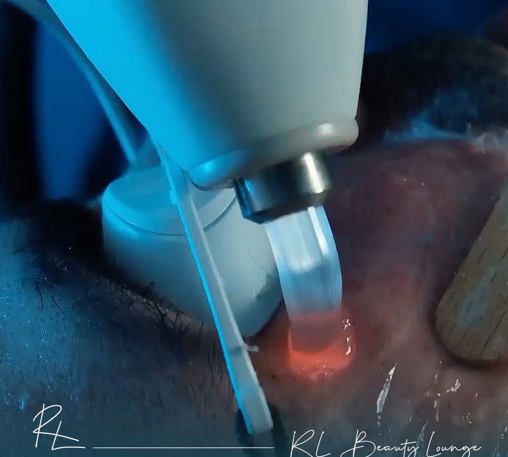 Alma Soprano ICE Titanium laser hair removal applicator at RL Beauty Lounge, Ankara